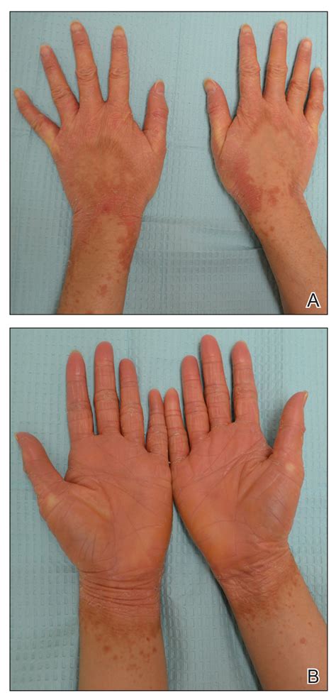 Atypical Presentation Of Pityriasis Rubra Pilaris Challenges In