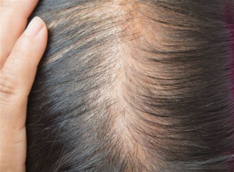 Why Is Your Hair Thinning And 12 Treatable Ways To Stop It True Spirit