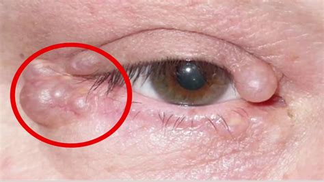 Eyelid Cysts Eyelid Cysts Treatment How To Get Rid Of A Stye Youtube