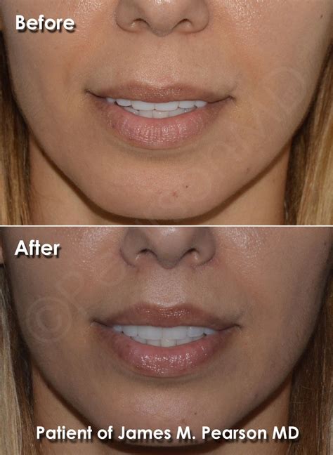Lip Shape Surgery Before And After