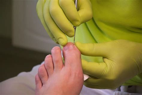 Ingrown Toenail Treatment By Your Foot Doctor Ankle And Foot Centers Of
