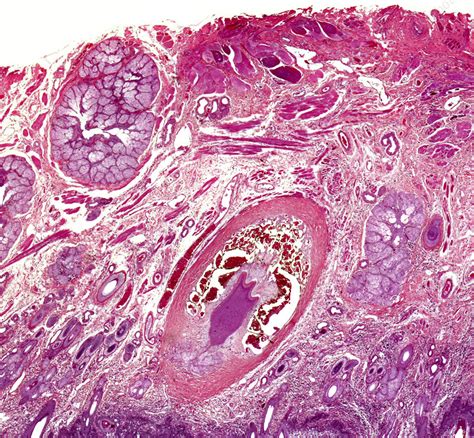 Squamous Cell Carcinoma Light Micrograph Stock Image C0494128