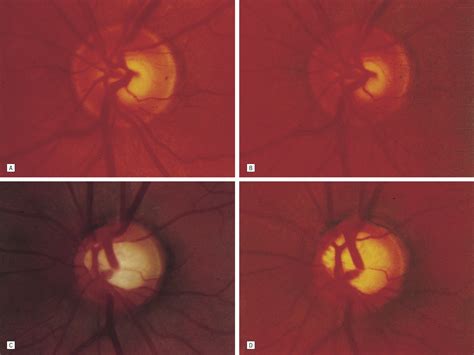 Clinical Factors Associated With Progression Of Glaucomatous Optic Disc