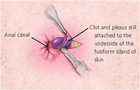 An inside story of a thrombosed pile. Hemorrhoid Medical Treatment Options ...