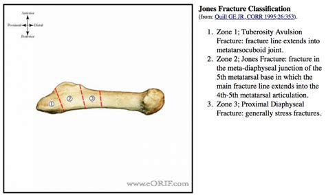 Jones Fracture S92.353A 825.25 | eORIF