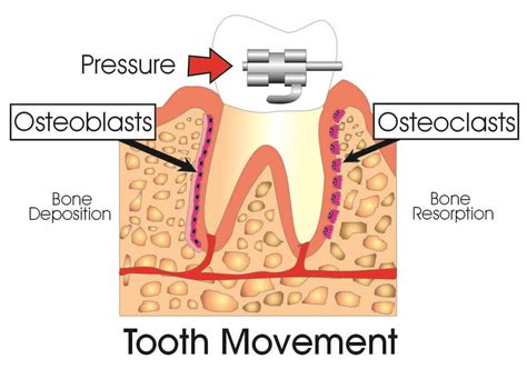 How Do Braces Work Ask An