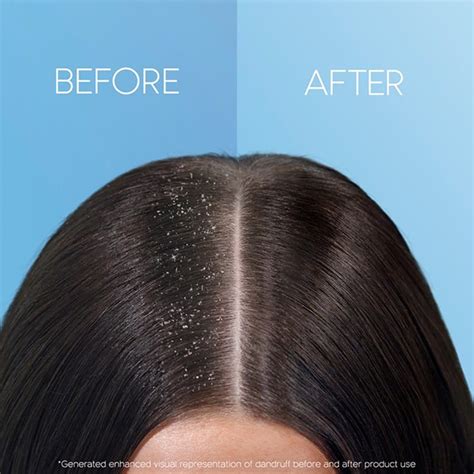 How To Stop Dandruff Fast And Effective Solutions Headandshoulders Uk