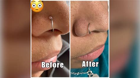 Get Rid Of That Nose Piercing Bumpkeloid For Good Find Out What Really Works Easiest Method