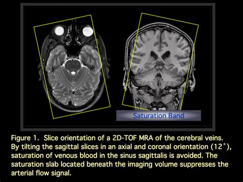 Thrombosis or cerebral venous thrombosis or sinus thrombosis) and treatment guideline. MRI BLOG: Dural Sinus Thrombosis