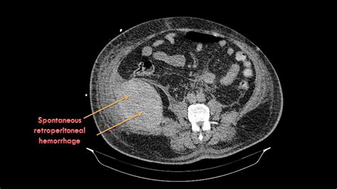 Ultimate Radiology Spontaneous Retroperitoneal Hemorrhage