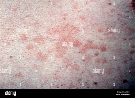 Pityriasis Rosea Hi Res Stock Photography And Images Alamy