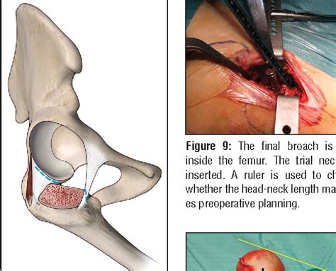 Figure 3 From Anterior Approach In Total Hip Replacement Semantic Scholar