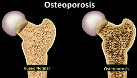 Guía De Osteoporosis Academia Nacional De Medicina De Colombia