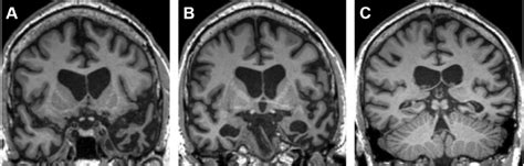 Brain Mri Findings In Patient Ba Coronal Sections Of Bas T1 Weighted