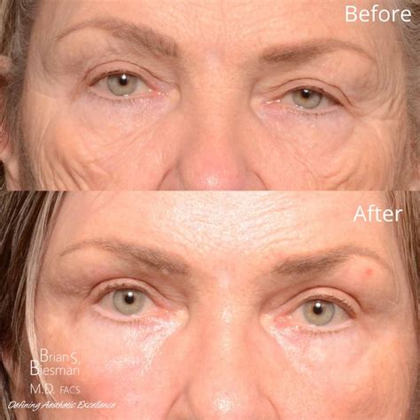Laser Under Eye Wrinkles Before After Augsburgermakowsky