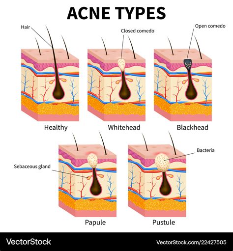 Acne Types Pimple Skin Diseases Anatomy Medical Vector Image