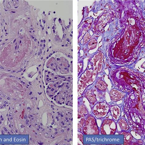 Ct scans for pleural effusion should be performed with contrast enhancement of the pleura and before complete drainage of pleural fluid. CT scan chest with IV contrast showing moderate bilateral ...