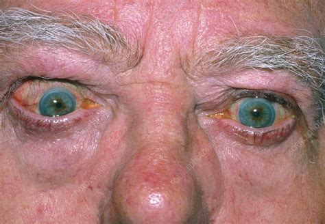 Bulging Eye Of Man With Thyrotoxicosis Stock Image M2700148