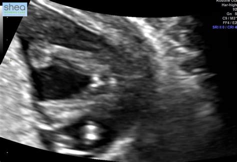 Hormones in your blood vary according to your stage of pregnancy. Can your pregnancy scan give the wrong due date?