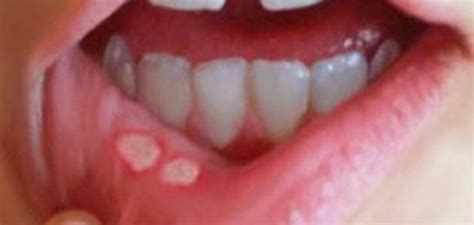 علاج قرحة الفم واللثة الأمراض التي تصيب الفم صباحيات