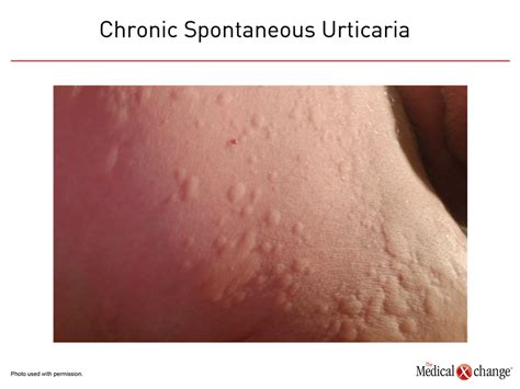 Chronic Spontaneous Urticaria Control In Primary Care The Medical