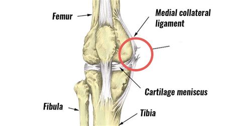 Medial Knee Ligament Mcl Sprain Symptoms Treatment And Exercises