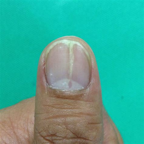 ■爪カンジダ症 症状としては爪白癬とほぼ同じ。 診断は培養でカンジタを検出すること。 治療は抗真菌薬の内服。 爪カンジダ 縦の線が入り先端が割れています. ずっと､爪の中から縦に線が入ってるんですが何かの病気 ...