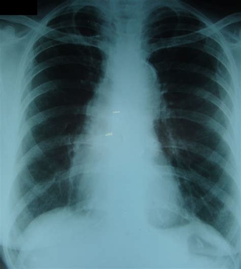 Intimal Calcification In Aortic Knuckle X Ray Chest Pa All About