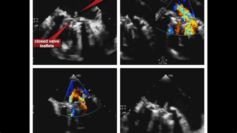 A Case Infective Endocarditis Of A Prosthetic Mitral Valve