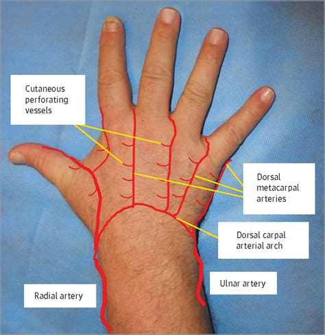 Local Fasciocutaneous Sliding Flaps for Soft-Tissue Defects of the