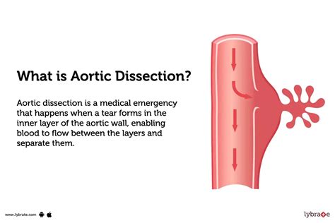 Aortic Dissection Causes Symptoms Treatment And Cost