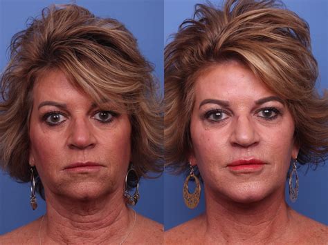 Facelift Before And After Pictures Case 365 Scottsdale Az Hobgood Facial Plastic Surgery