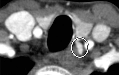 Parathyroid 4d Ct What The Surgeon Wants To Know Radiographics