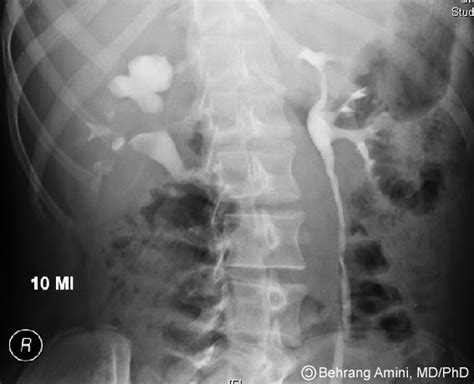 Roentgen Ray Reader Infundibular Stenosis