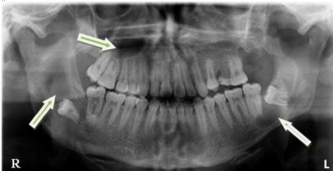 Panoramic View Showing Multiple Radiolucent Lesions In The Mandible And