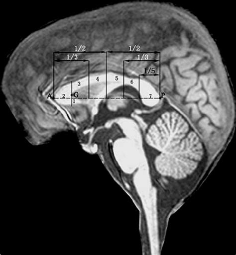 Sub Divisions And Morphometric Assesment Of Corpus Callosum Adapted Download Scientific