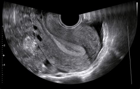 Normal Cervix Ultrasound