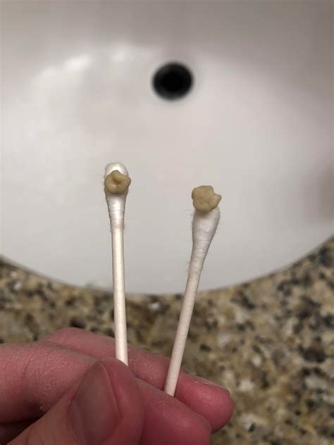 Two Tonsil Stones I Got Out After Being Sick For A Week The Smell Was