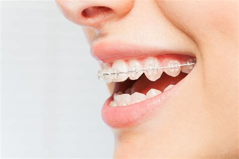 voce conhece  aparelho ortodontico autoligado