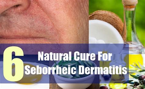 6 Natural Cure For Seborrheic Dermatitis Dorothee Padraig South West
