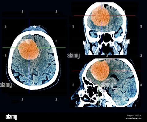 meningioma cáncer cerebral color de la tomografía computarizada tc a través del cerebro de un