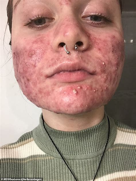 Woman Whose Cystic Acne Left Her In Extreme Pain And Suicidal Finds