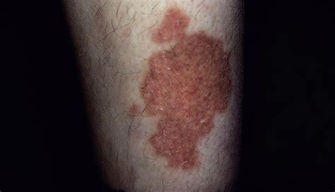 A Spreading Shin Rash Signifies Systemic Disease The Clinical Advisor