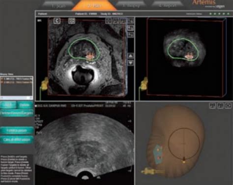 Mritrus Fusion Biopsies Why Mritrus Prostate Biopsy Sperling