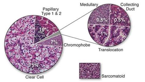 Types Of Kidney Cancer Kidney Cancer Ucla Health