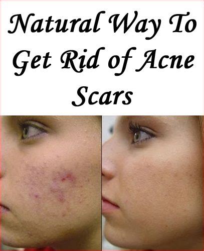 How To Heal Acne Scars Naturally Dane101