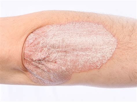 Psoriasis Updates And Side By Side Treatment Review