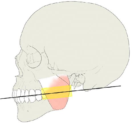 Scanning Level Of The Masseter Muscle In Axial Imaging Yellow Area