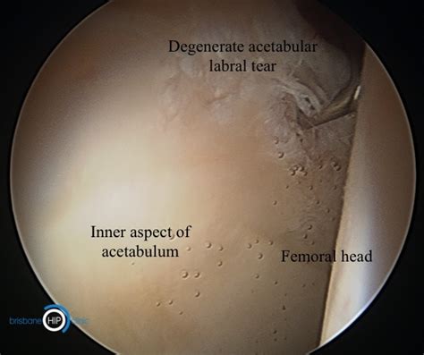 Acetabular Labral Tear Brisbane Hip Clinic Australia