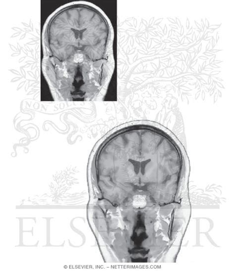 Coronal Sections Through The Forebrain Level 3 Anterior Commissure